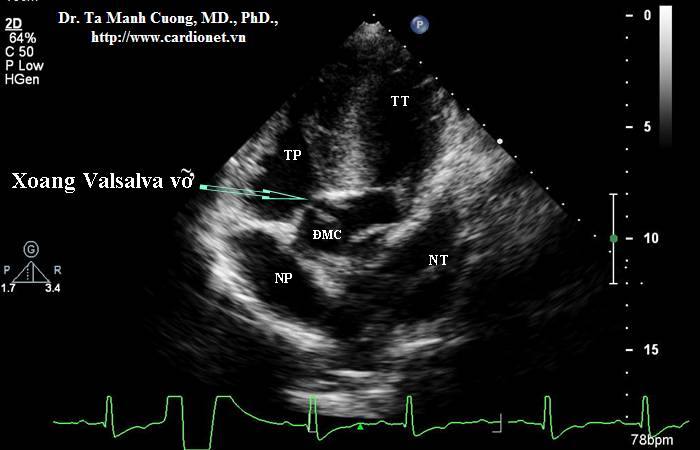 valsalva induced perforated eardrum